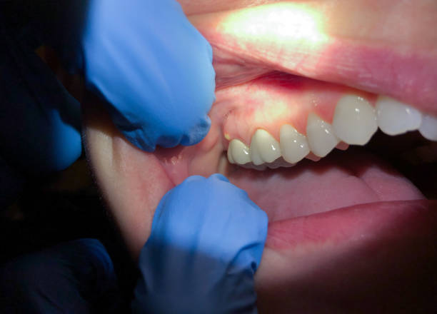 Best Emergency Dental Care for Sports Injuries in Santa Anna, TX